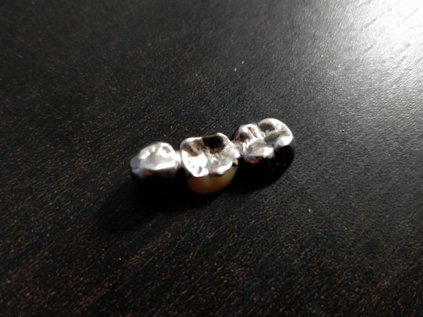 大きな詰め物に使う「銀歯」メリットとデメリット | 松陰神社前徒歩0分  