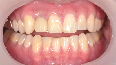 せたがや歯科室｜ブログ｜【症例】前歯のインプラントに対するジルコニアオールセラミック治療｜仮歯装着後の画像