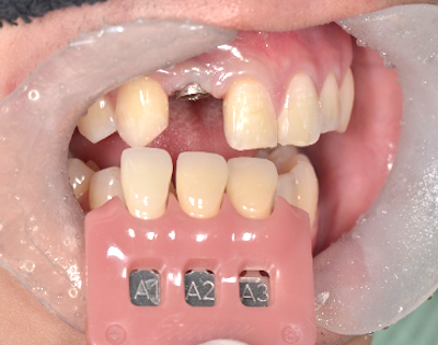 せたがや歯科室｜ブログ｜【症例】前歯のインプラントに対するジルコニアオールセラミック治療｜歯の写真撮影の画像