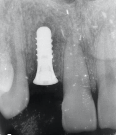 せたがや歯科室｜ブログ｜【症例】前歯のインプラントに対するジルコニアオールセラミック治療｜治療前のレントゲン画像
