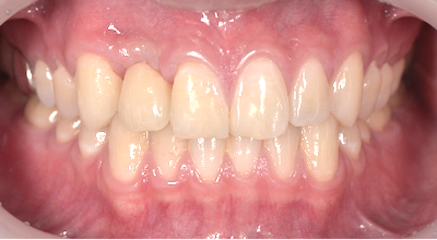せたがや歯科室｜ブログ｜【症例】前歯のインプラントに対するジルコニアオールセラミック治療｜治療後の歯の画像