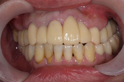 せたがや歯科室｜ブログ｜【症例】セラミックによる前歯の審美的矯正治療｜セラミック装着時