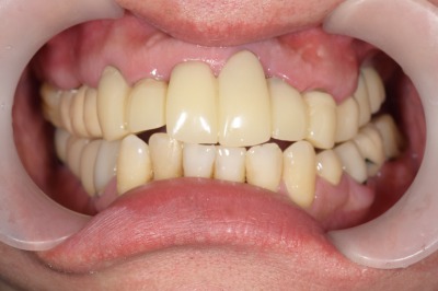 せたがや歯科室｜ブログ｜【症例】セラミックによる前歯の審美的矯正治療｜仮歯装着時