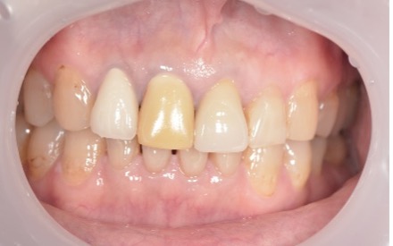 せたがや歯科室｜ブログ｜症例｜【症例】前歯のジルコニアセラミック治療｜治療前画像