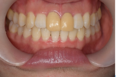 せたがや歯科室｜歯科衛生士ブログ｜【症例】変色した仮歯をセラミックで修復｜治療前