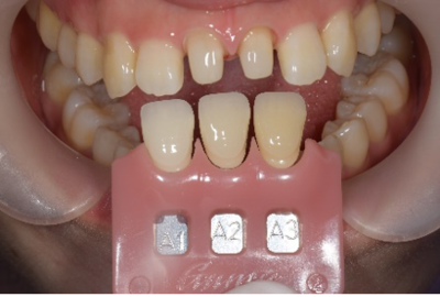 せたがや歯科室｜歯科衛生士ブログ｜【症例】変色した仮歯をセラミックで修復｜治療詳細