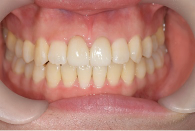 せたがや歯科室｜歯科衛生士ブログ｜【症例】変色した仮歯をセラミックで修復｜治療後
