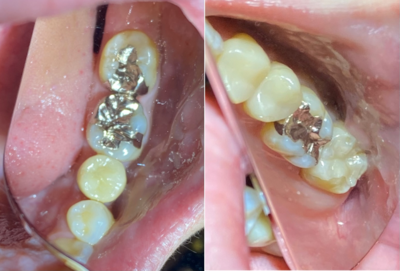 せたがや歯科室｜歯科衛生士ブログ｜【症例】銀歯を白く美しく、強い被せ物に｜治療前画像