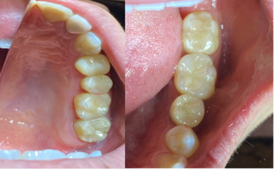 せたがや歯科室｜歯科衛生士ブログ｜【症例】銀歯を白く美しく、強い被せ物に｜治療後画像